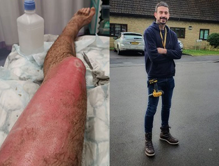 Picture of Richard Bingham who was injured, and his injured leg 